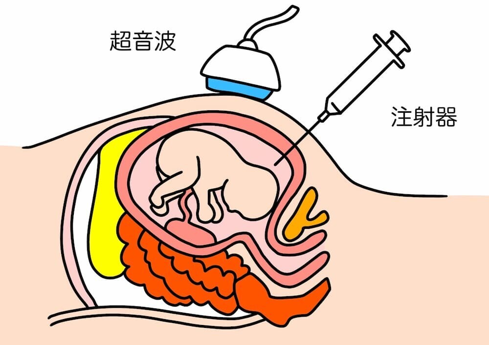  羊水検査 イラスト
