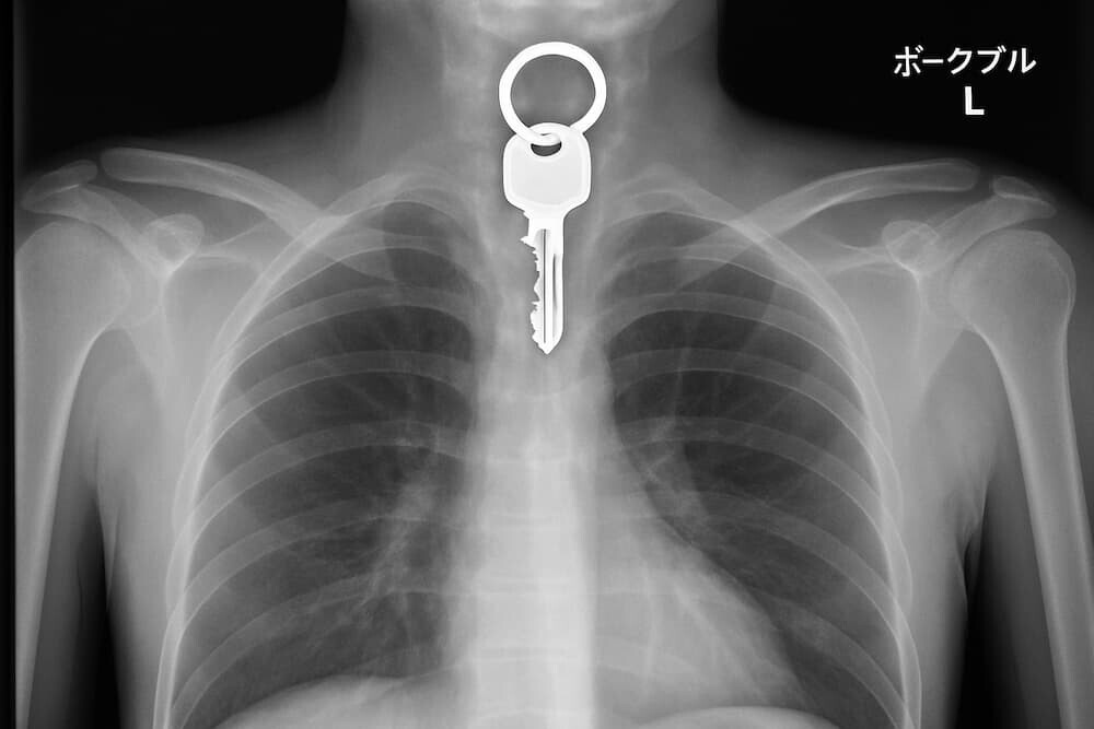 82歳男性の喉から12センチの鍵発見！