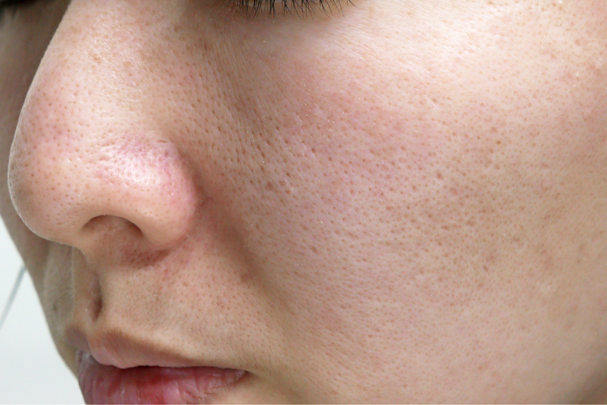 痛くないダーマペン×マッサージピール！毛穴の引き締め＆なめらか肌を