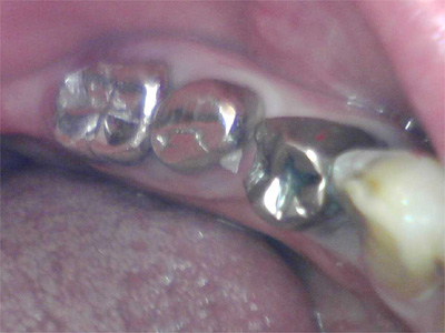 f:id:orangedental:20180310222650j:plain f:id:orangedental:20180310222650j:plain