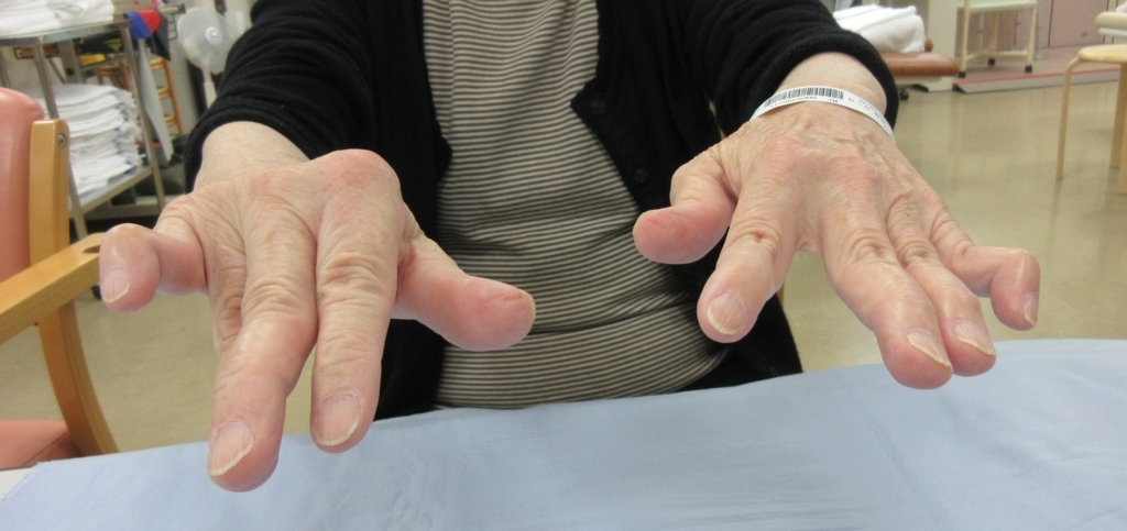 SND はどのように診断されますか?