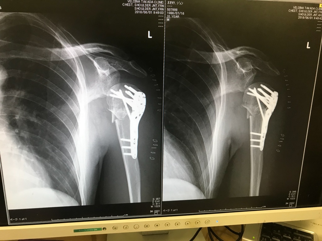 落車 そして上腕骨骨折からの復活日記 10日目 30代二児の子持ち男が 自転車競技チーム を作ってみたらどうなるの