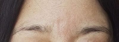 ミケンディープパッチを口コミします ボトックスでもダメだった眉間の縦ジワに貼ってみたら 歳を隠すのをやめました