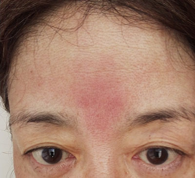 シミと肝斑が4カ月で薄くなりました トレチノインと家庭用レーザーを毎日続けた結果 歳を隠すのをやめました