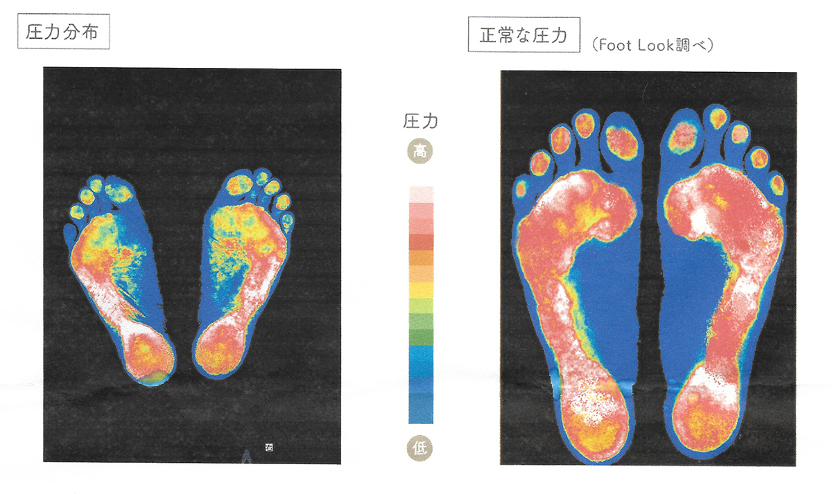 足底の圧力分布