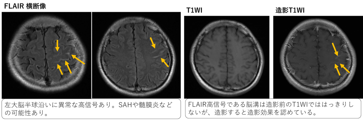 細菌性髄膜炎