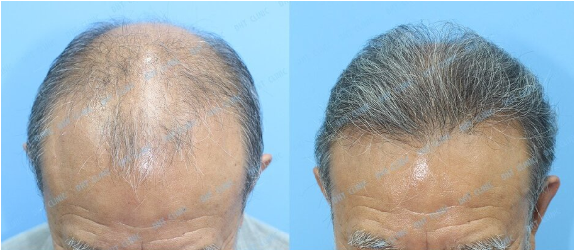 73歳広範囲薄毛☆2955株植毛で若返り - タイ植毛 バンコク DHT