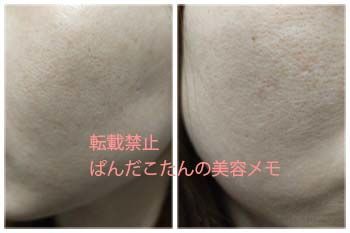 セルフダーマペン2回目から2週間後の肌