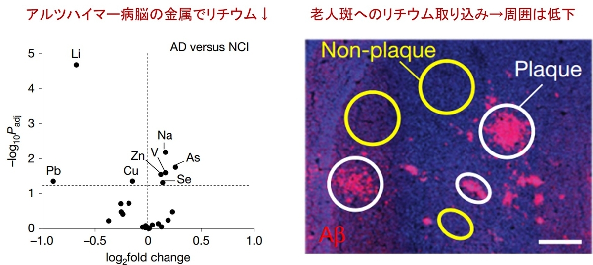 脳内のリチウム欠乏がアルツハイマー病を引き起こす！？ - Neurology
