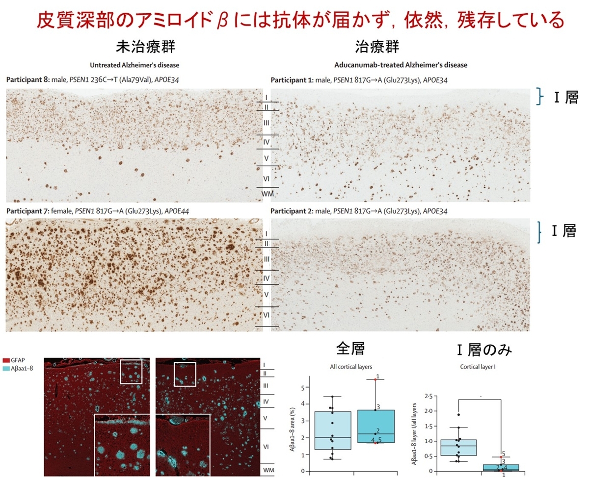 アデュカヌマブによるアミロイドβ除去は脳表近くに限られている