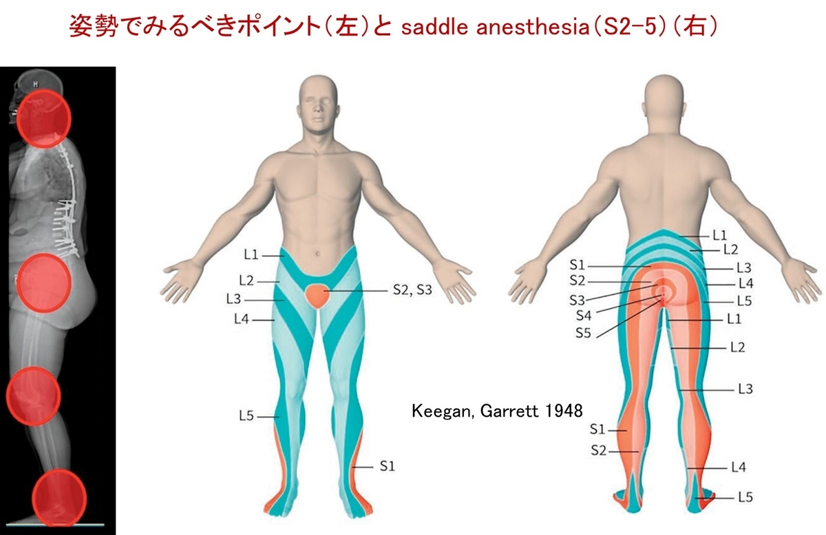 腰痛：「見逃してはならない病態」と画像検査前の診察のコツ