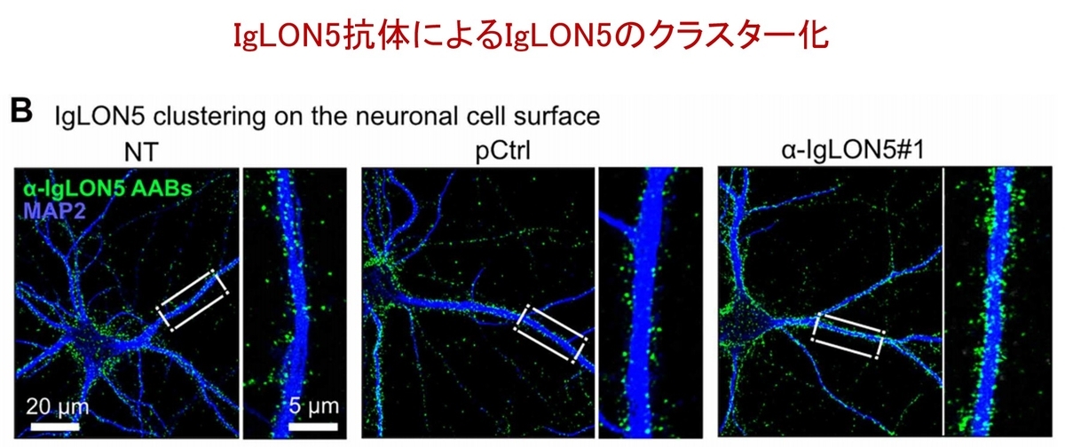 IgLON5抗体はなぜタウ病理を起こすのか?―神経細胞の過活動がタウ局在異常をもたらす! - Neurology 興味を持った「脳神経内科」論文