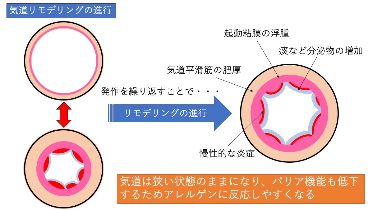 f:id:pkoudai:20200830194237p:plain 気道リモデリング