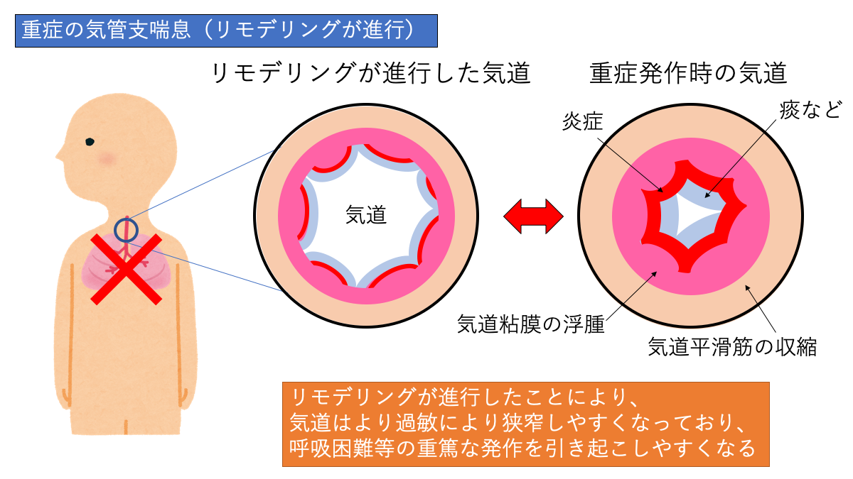 f:id:pkoudai:20200830194252p:plain 重症化した気管支喘息