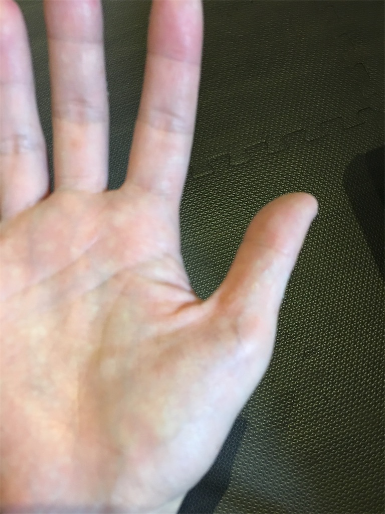 大人の手足口病 その後の経過 高齢ママのひとりごと