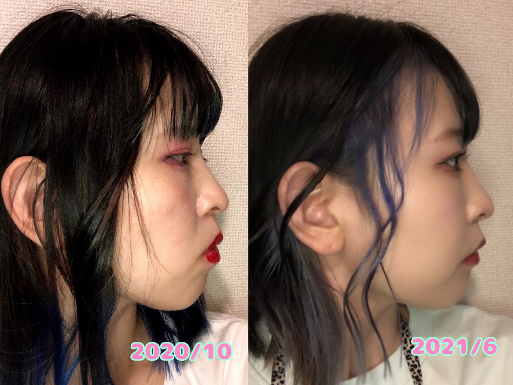 歯列矯正 いつか死ぬけど歯ぁ動かす Rariwow Info