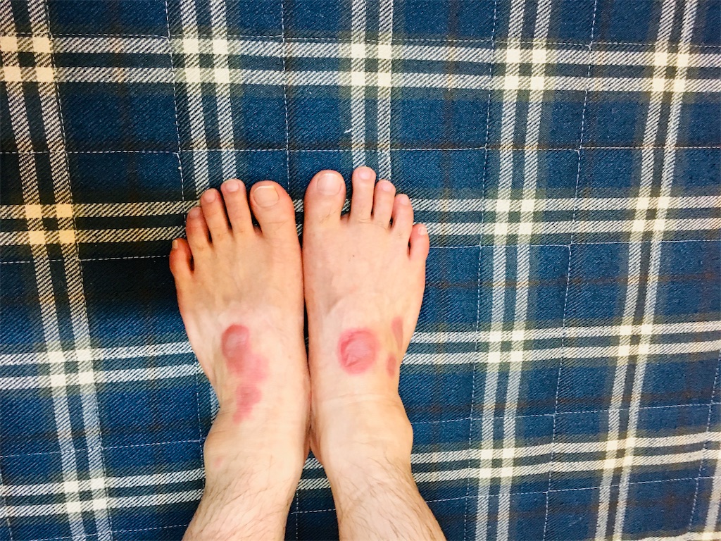 夫の薬疹が以前よりもヒドいことに - ぽこあぽこ あしあと帳