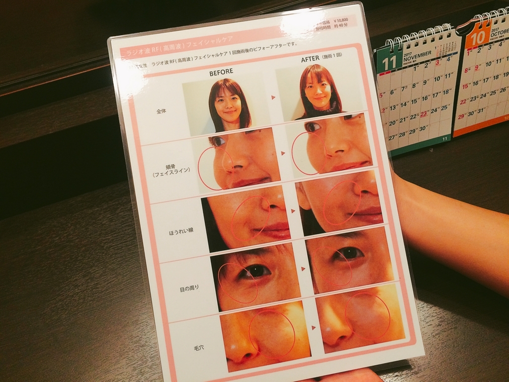 f:id:poyohiyo:20171003111637j:plain