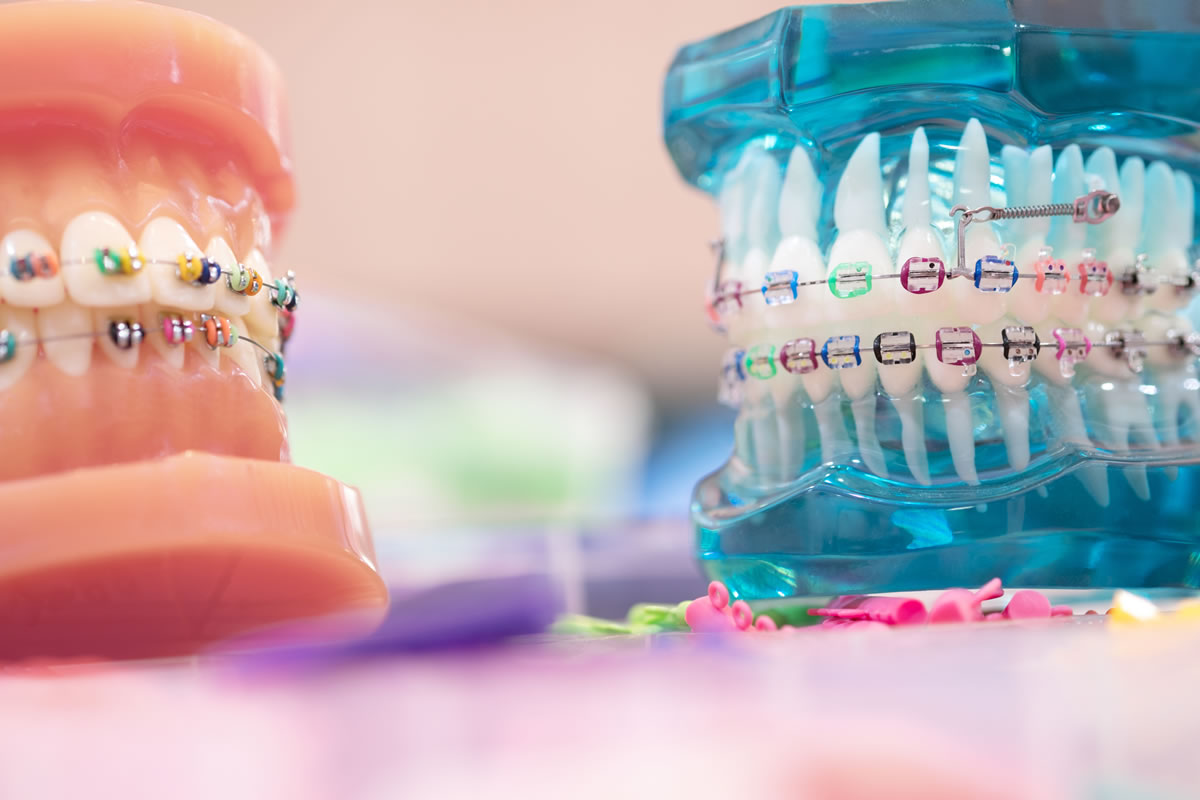 f:id:practiceorthodontic:20200926180812j:plain