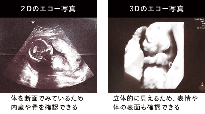 医師監修 エコー写真ってどう見るの ３d ４dエコーって何 ガジェット通信 Getnews