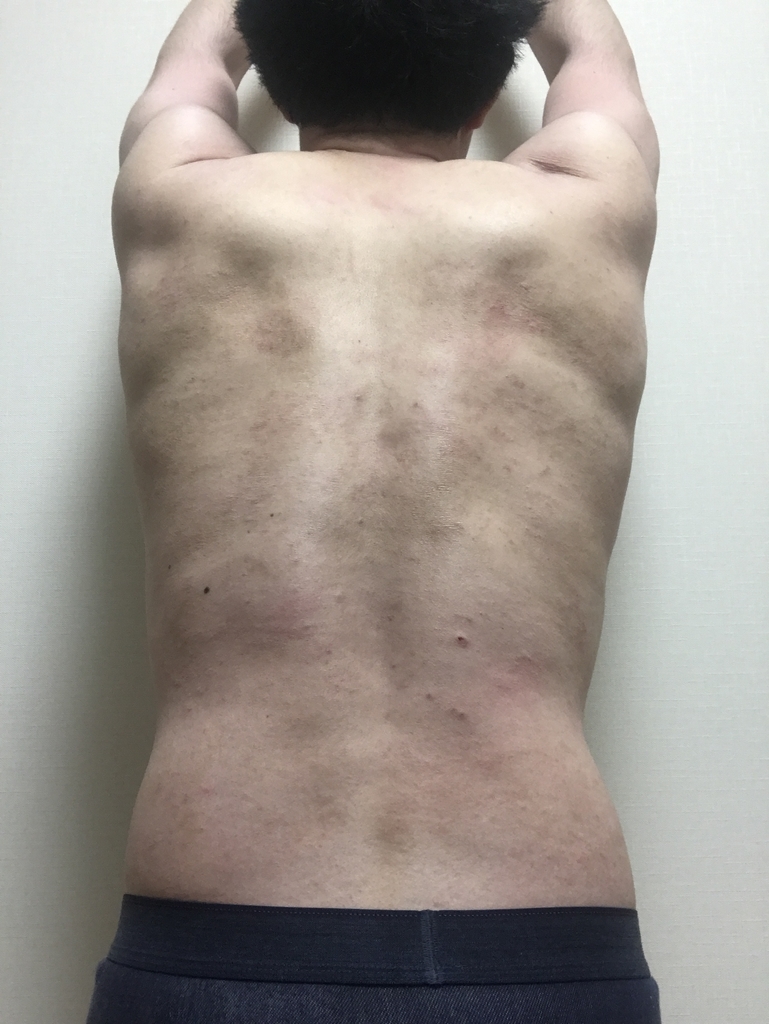 自分のアトピー遍歴について - アトピー性皮膚炎とデ ...