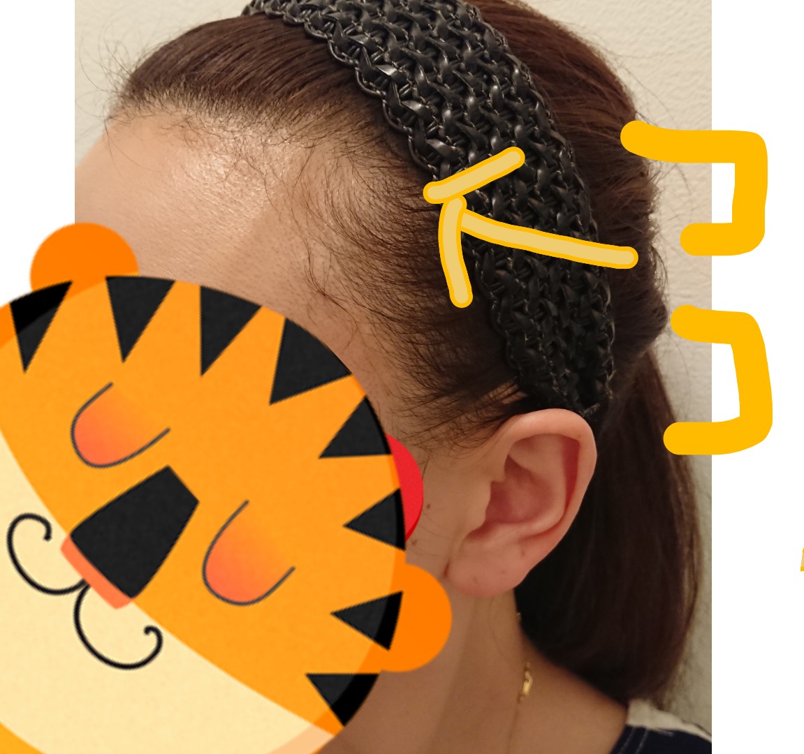 韓国へ行く 植毛決めた女の広がるおでこ ついに韓国へ 植毛女子ヘアライン修正