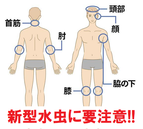 体部白癬 それ湿疹じゃないかも 上半身に発症する 新型水虫 に要注意 被っているのはアレだけ