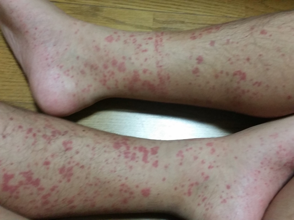 突然ですが、アナフィラクトイド紫斑で足に筋肉痛、関節痛、赤い斑点の病気になった闘病記 To Live A Free Life