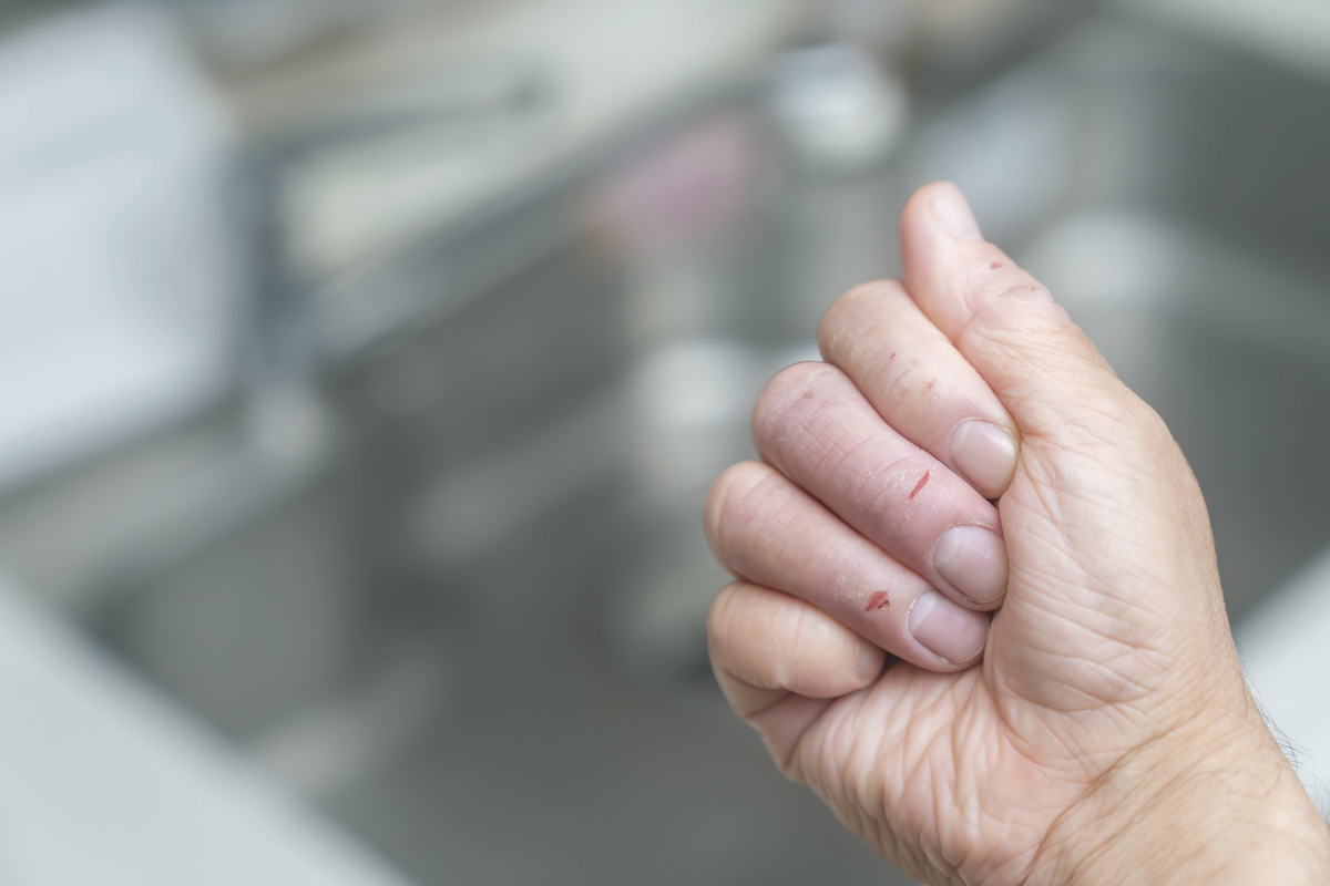 皿洗いによる手荒れを気にする人のイメージ