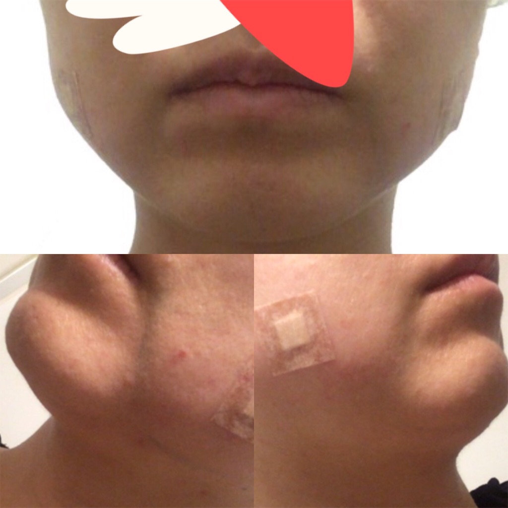 アラサーolが効果があった美容法を写真付き口コミレポート 脂肪溶解注射 レチノール プチ整形 スキンケア たるみ治療