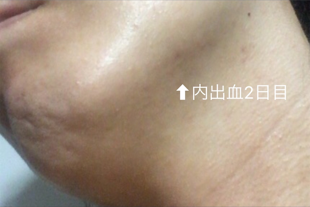 脂肪溶解注射 カベリンの効果 写真で口コミレポート 2回目 アラサーolが効果があった美容法を写真付き口コミレポート 脂肪溶解注射 レチノール プチ整形 スキンケア たるみ治療