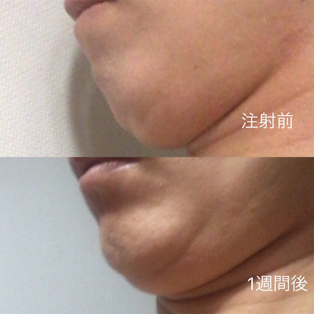 脂肪溶解注射 カベリンの効果 写真で口コミレポート 2回目 アラサーolが効果があった美容法を写真付き口コミレポート 脂肪溶解注射 レチノール プチ整形 スキンケア たるみ治療