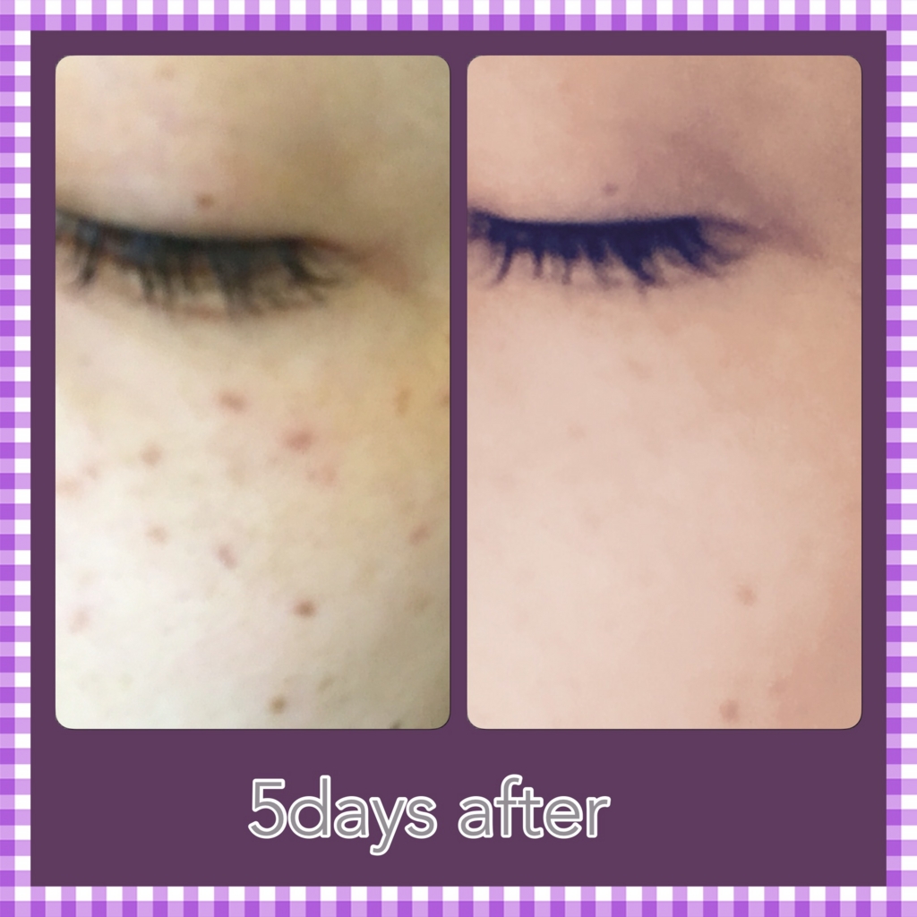 ディオーネ しみデトックス５回目レポ 40代で幸せ離婚 美活 就活 離活記録