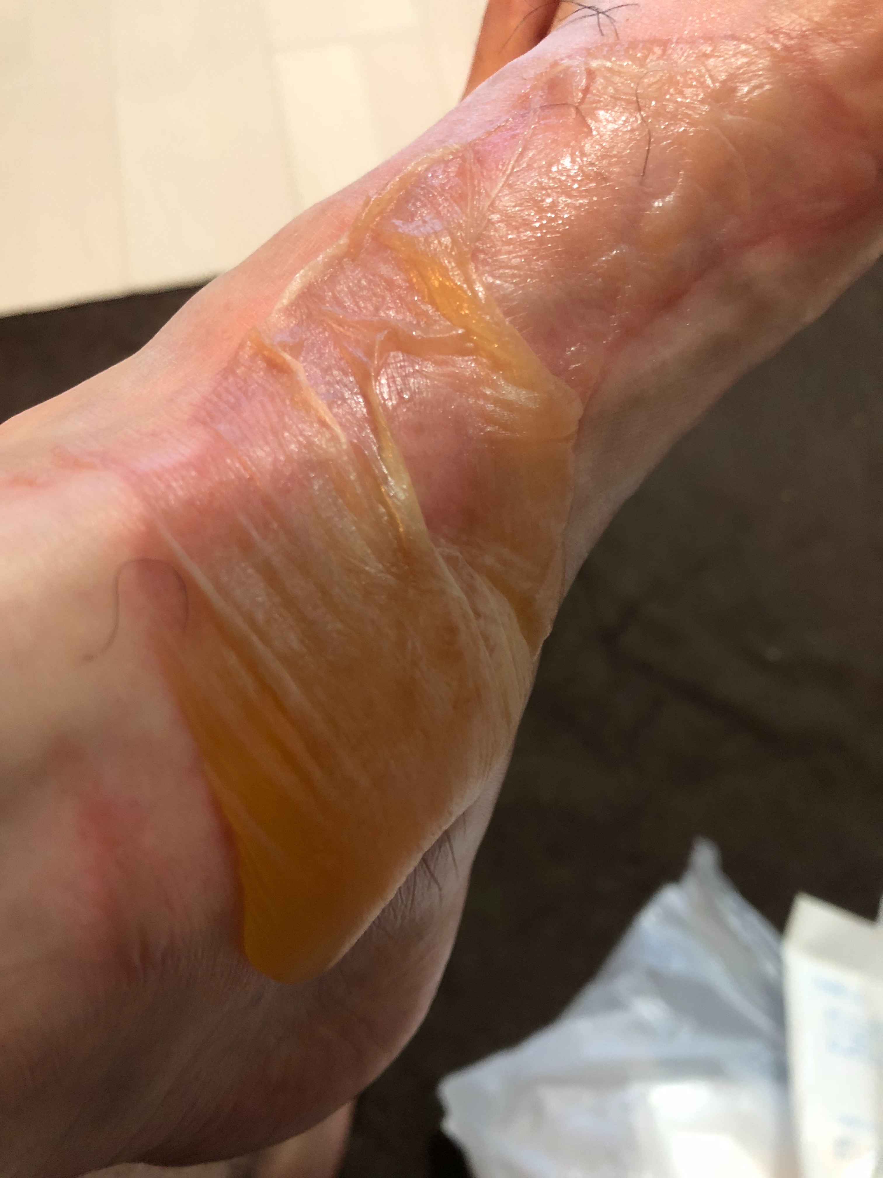 f:id:roshgoom:20190524134247j:image 足の火傷2日目