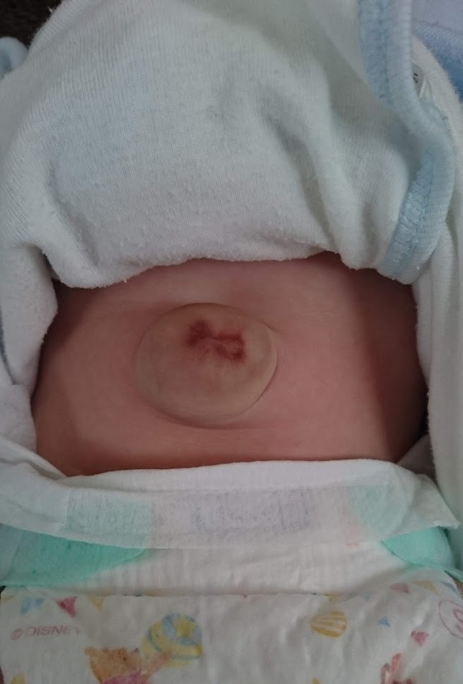 きれいに治る 低出生体重児の赤ちゃんのでべそ 臍ヘルニア ちゃーちゃんとるーちゃんず
