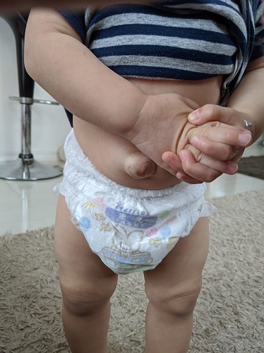 でべそ　臍ヘルニア　一歳