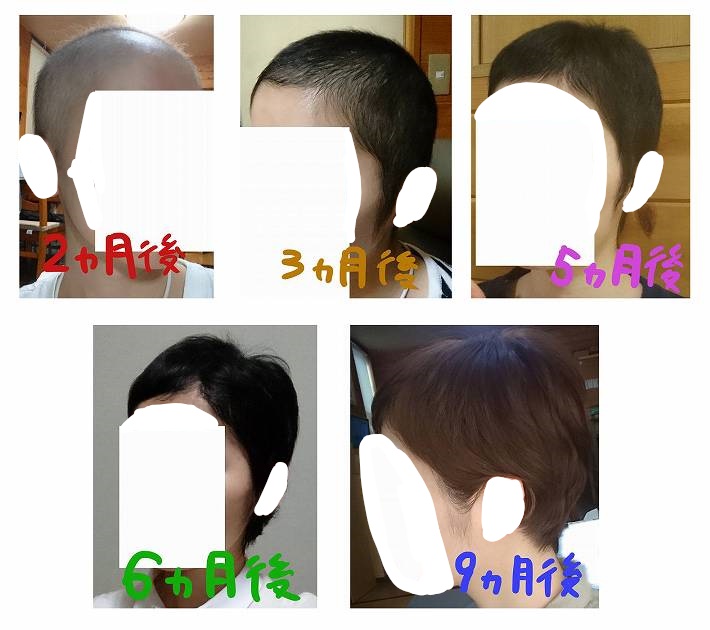副作用 脱毛 おすすめウィッグ シャンプーと髪の成長記録 Rurikoの治療メモ