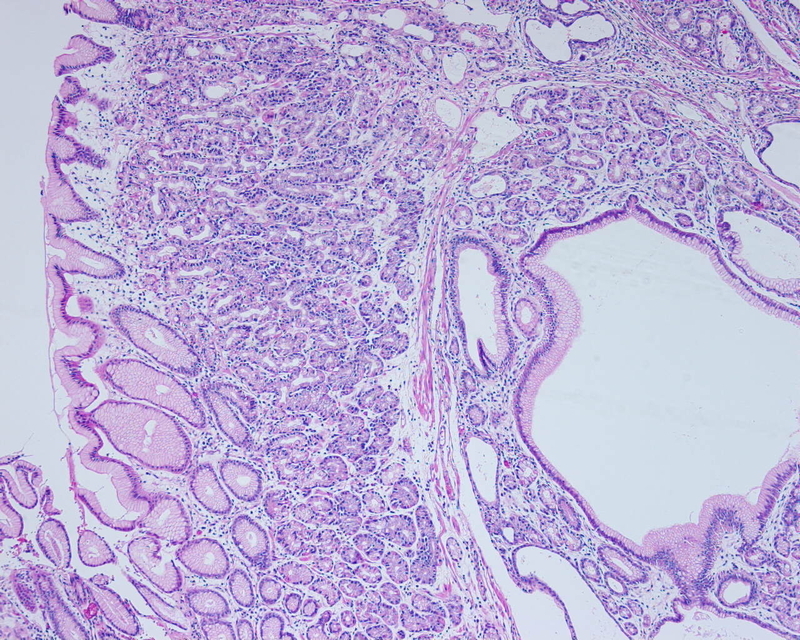 Hamartomatous Inverted Polyp of Stomach (3) - 胃生検の小部屋 Cottage for ...