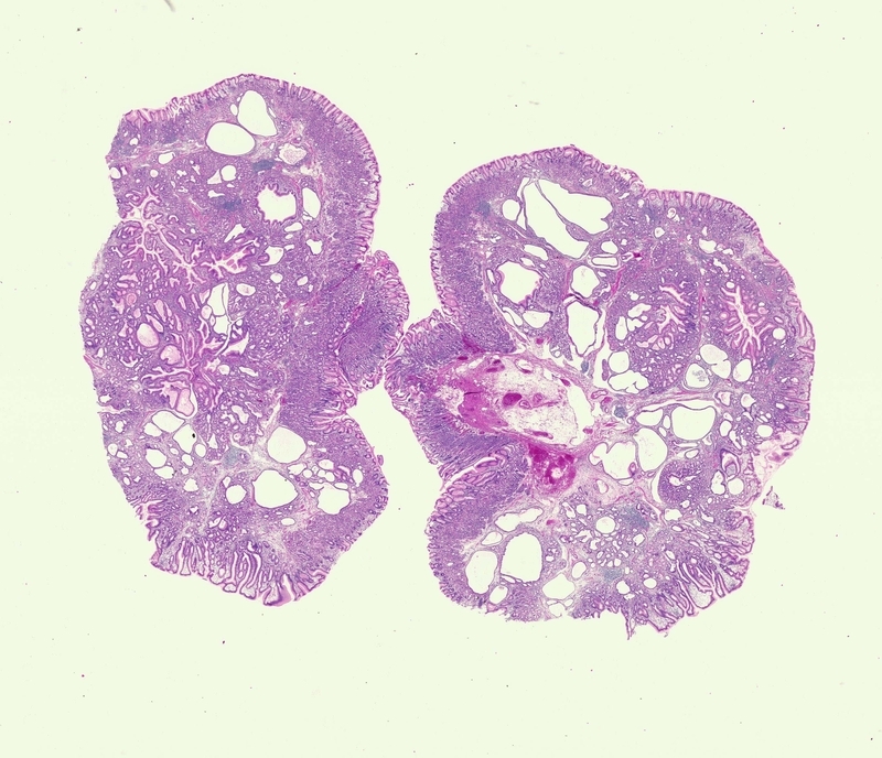 Hamartomatous Inverted Polyp of Stomach (1) - 胃生検の小部屋 Cottage for ...