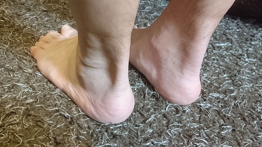 治ったんだけど アキレス腱ぐじゅぐじゅ問題を記録しておくよ Club Well Done