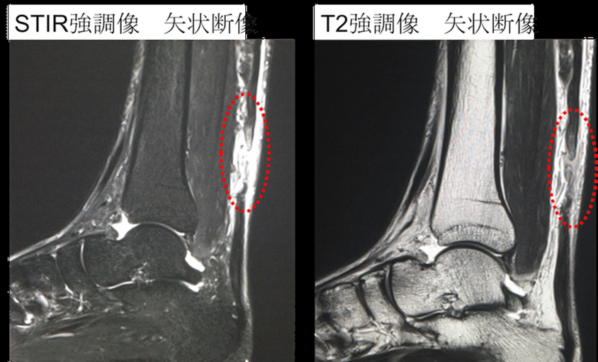 腱板損傷のためのより安全な運動はありますか?