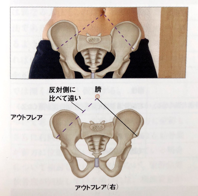 骨盤の評価 骨盤帯の機能異常 腸仙関節・仙腸関節・恥骨結合 野球 × 理学療法士