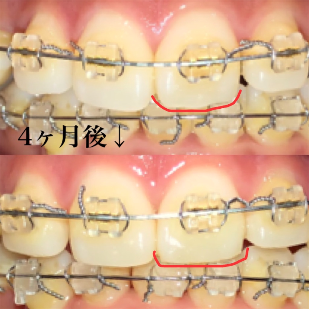 矯正治療で前歯が削れた… - もりぶろ