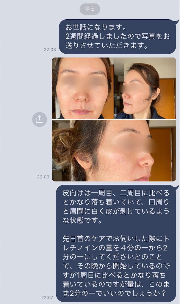前半 トレチノイン今の使用量であってるのか不安 ゼオスキン16日目 セラピューティック 肌の衰えを感じてアラフォーもがく