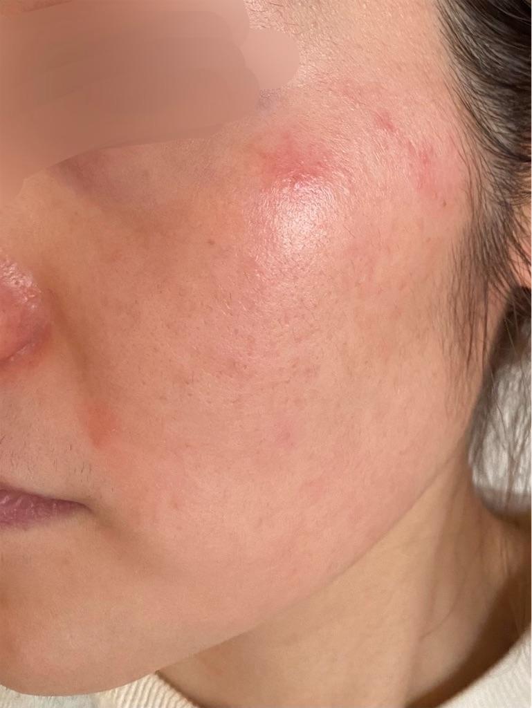 34日目にして問題発生 小鼻のニキビと頬のぶつぶつ ゼオスキン セラピューティック 肌の衰えを感じてアラフォーもがく