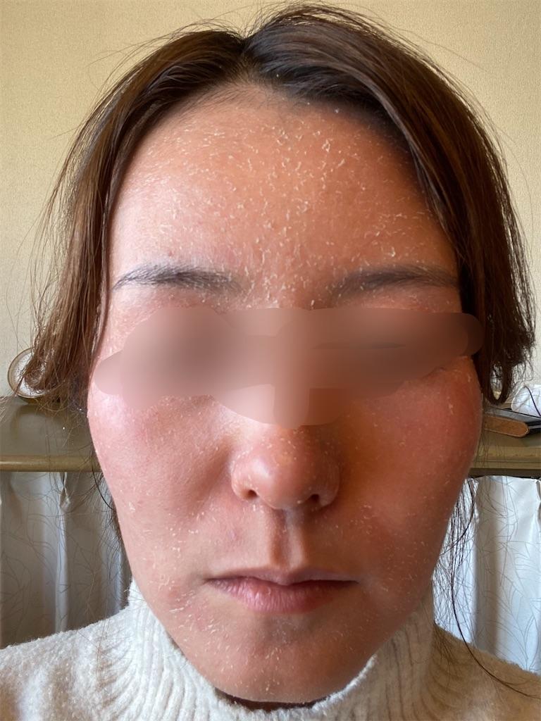 肌の衰えを感じてアラフォーもがく