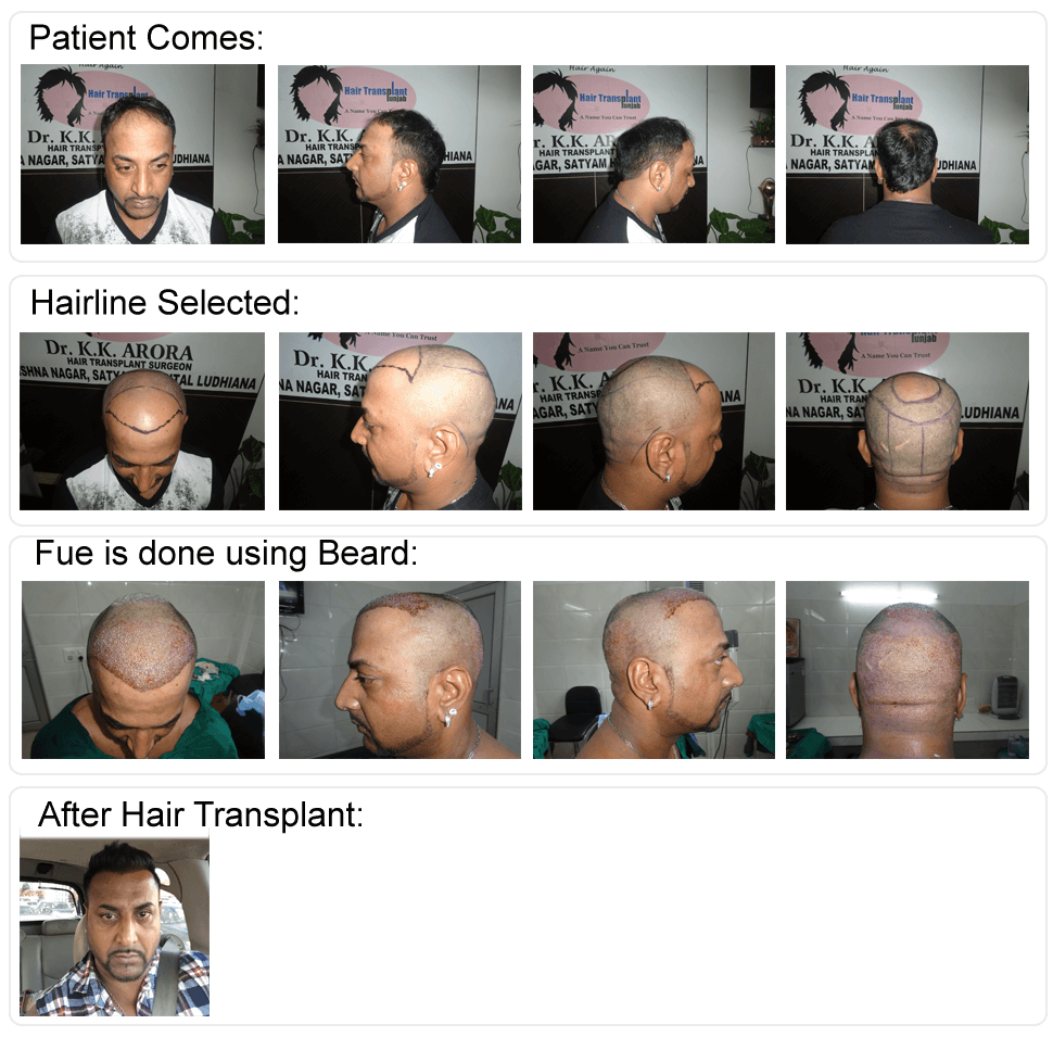 f:id:satyamhairtransplant:20170123182741p:plain f:id:satyamhairtransplant:20170123182741p:plain