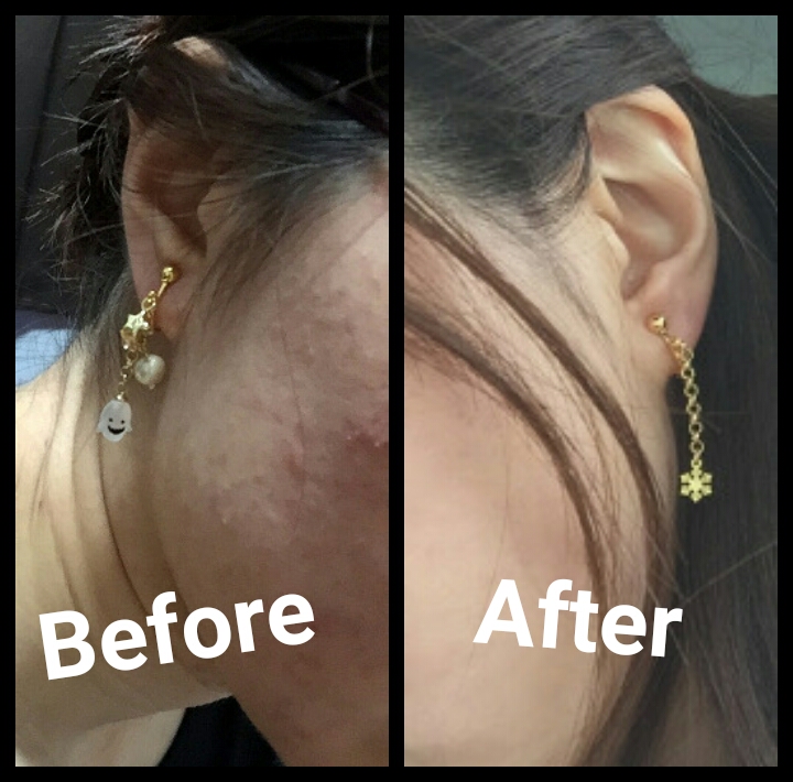 f:id:sawabihada:20170316182840j:plain f:id:sawabihada:20170316182840j:plain