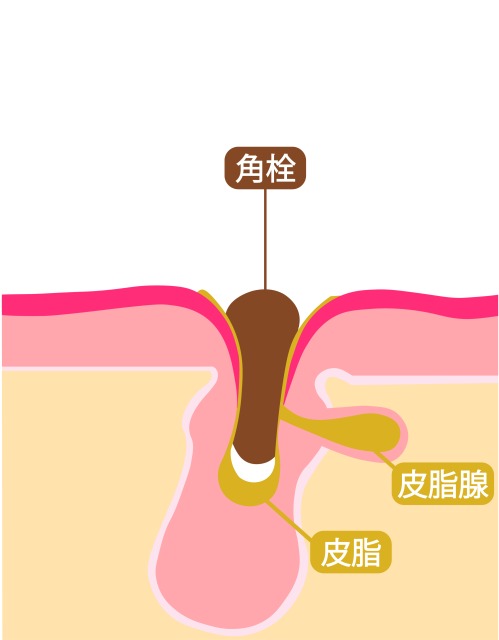 角栓