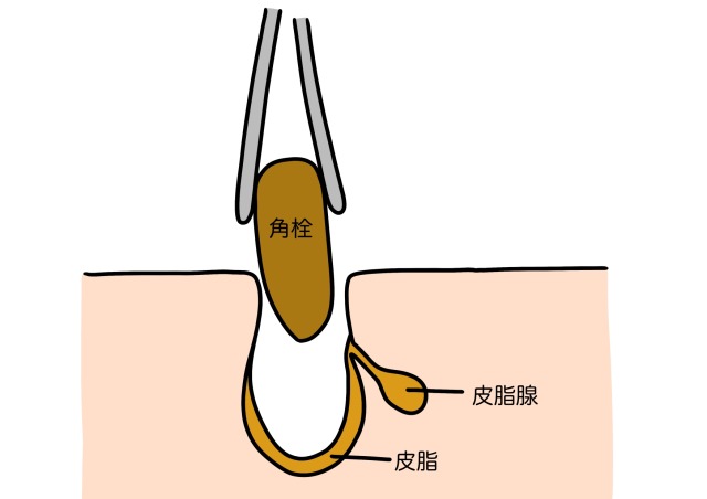 角栓を抜く